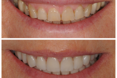 Smile 27: THE MAGIC OF VENEERS! Optimierung der Zahnform und der Zahnfarbe sowie Zahnlückenkorrektur durch high-end Veneers in nur in einem Schritt.